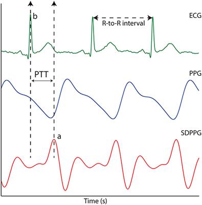 Photoplethysmography for Quantitative Assessment of Sympathetic Nerve Activity (SNA) During Cold Stress